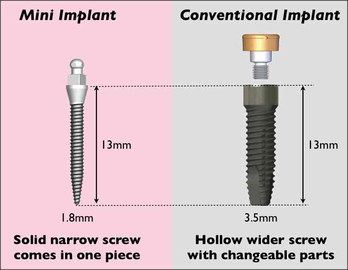 mini implant diagram