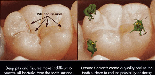 Fissure seal graphic