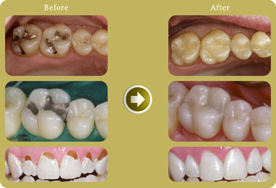 tooth coloured fillings and amalgam replacement