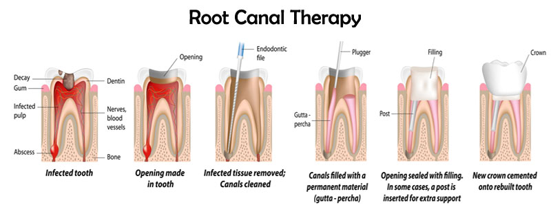 Root Canal Graphic